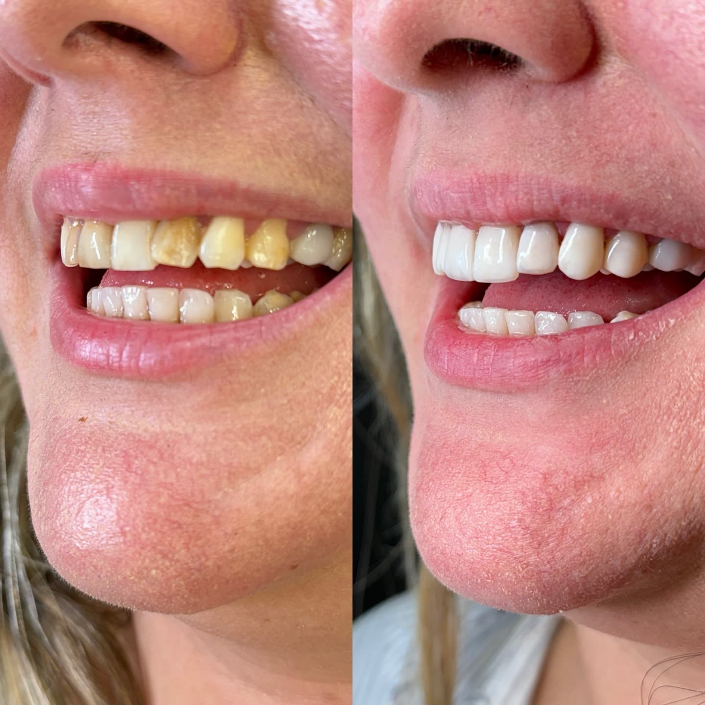 Depois — Transformação com lentes de resina — caso real