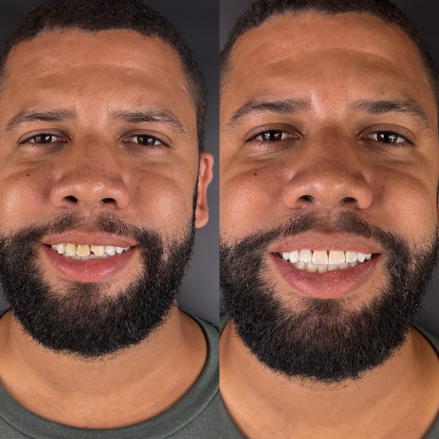 Depois — Resultado lentes de resina — transformação real