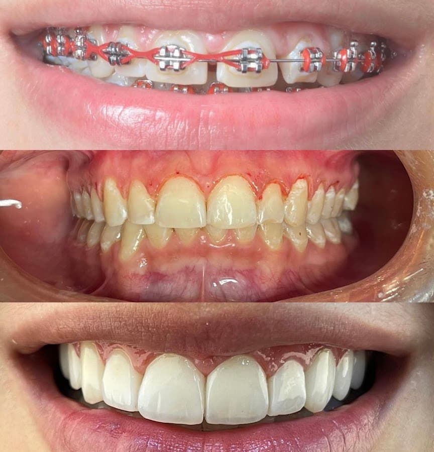 Facetas em resina — resultado realista